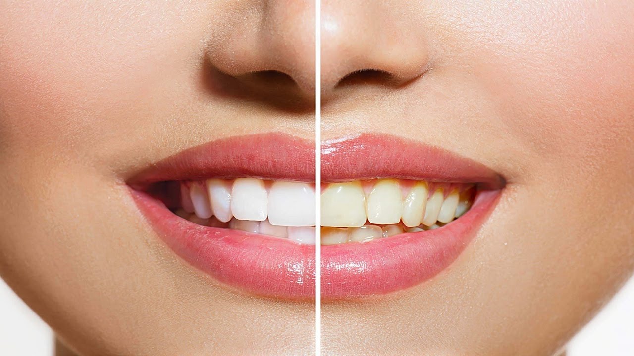 Diş sağlığınız için doğal çözüm: Sapsarı dişlere inci gibi beyazlık!